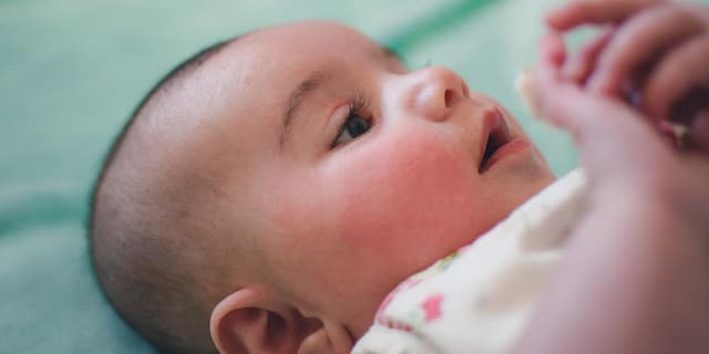 Atopic Dermatitis in Babies